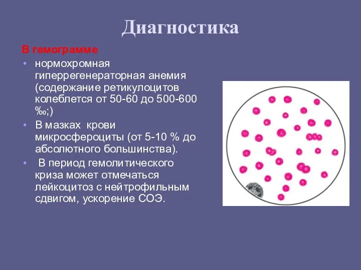 Диагностика В гемограмме нормохромная гиперрегенераторная анемия (содержание ретикулоцитов колеблется от