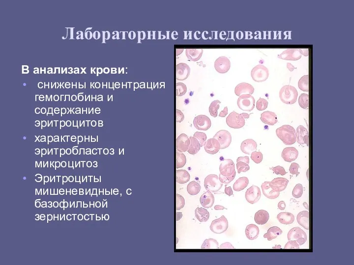 Лабораторные исследования В анализах крови: снижены концентрация гемоглобина и содержание