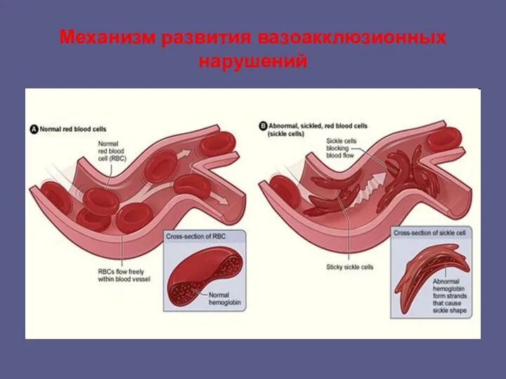 Механизм развития вазоакклюзионных нарушений