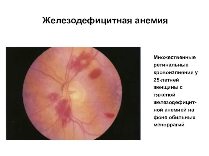 Железодефицитная анемия Множественные ретинальные кровоизлияния у 25-летней женщины с тяжелой железодефицит-ной анемией на фоне обильных меноррагий