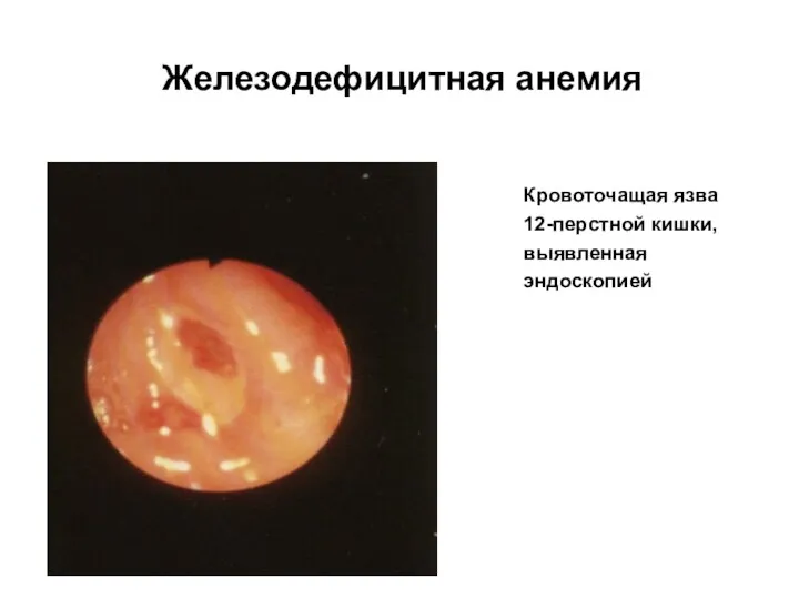 Железодефицитная анемия Кровоточащая язва 12-перстной кишки, выявленная эндоскопией