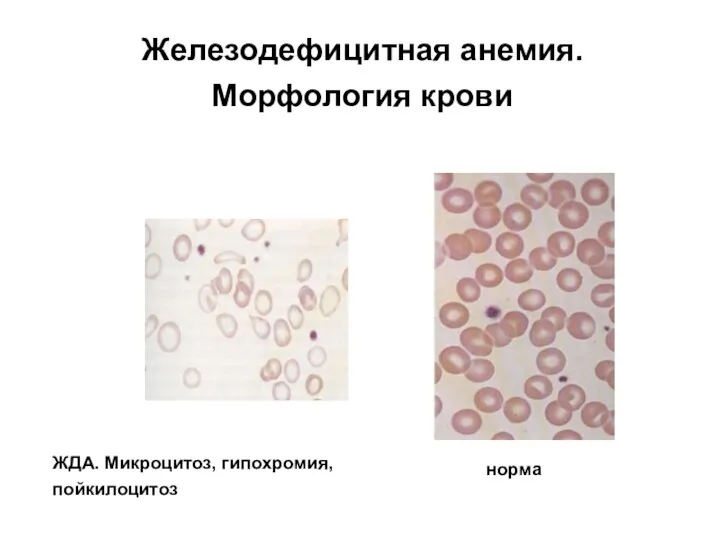 Железодефицитная анемия. Морфология крови ЖДА. Микроцитоз, гипохромия, пойкилоцитоз норма