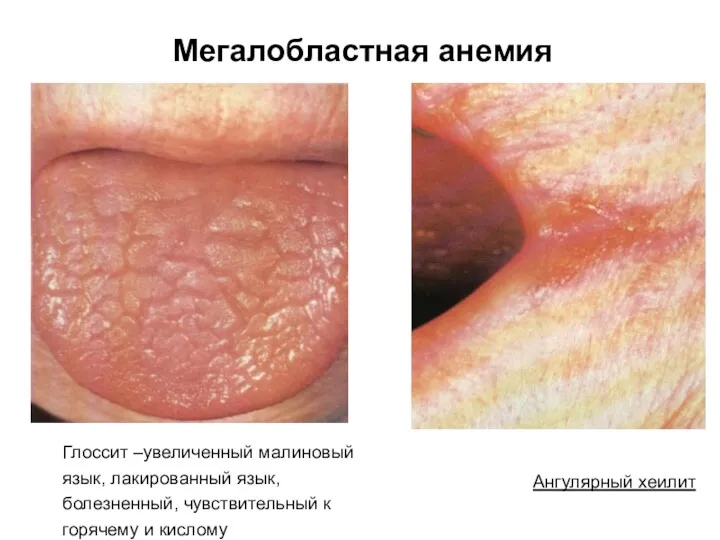 Мегалобластная анемия Глоссит –увеличенный малиновый язык, лакированный язык, болезненный, чувствительный к горячему и кислому Ангулярный хеилит