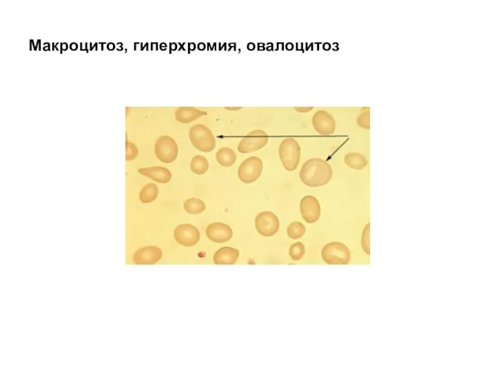 Макроцитоз, гиперхромия, овалоцитоз