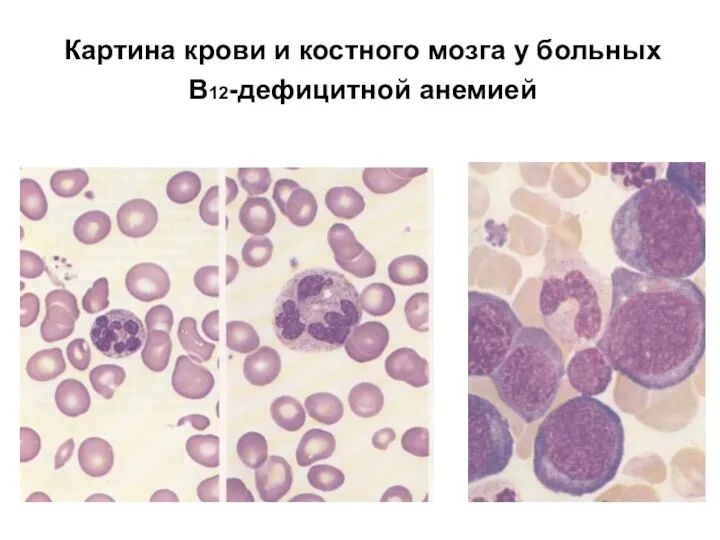 Картина крови и костного мозга у больных В12-дефицитной анемией