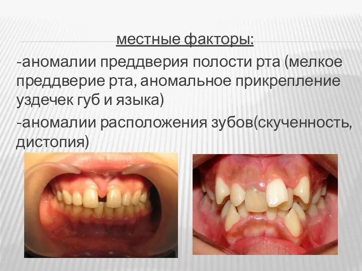 местные факторы: -аномалии преддверия полости рта (мелкое преддверие рта, аномальное