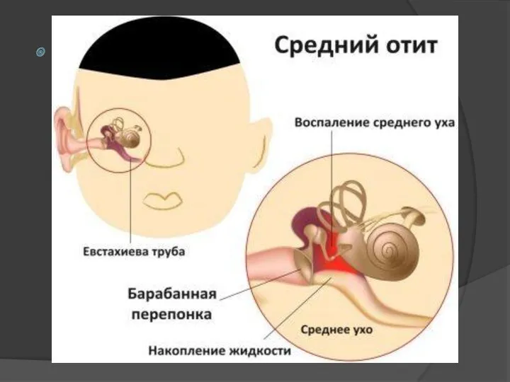 Средний отит проявляет себя «прострелами» в ухе, боль усиливается, а