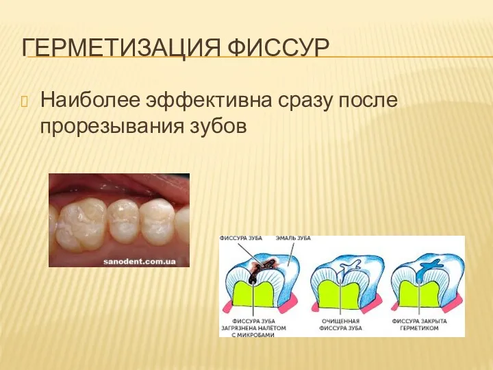 ГЕРМЕТИЗАЦИЯ ФИССУР Наиболее эффективна сразу после прорезывания зубов