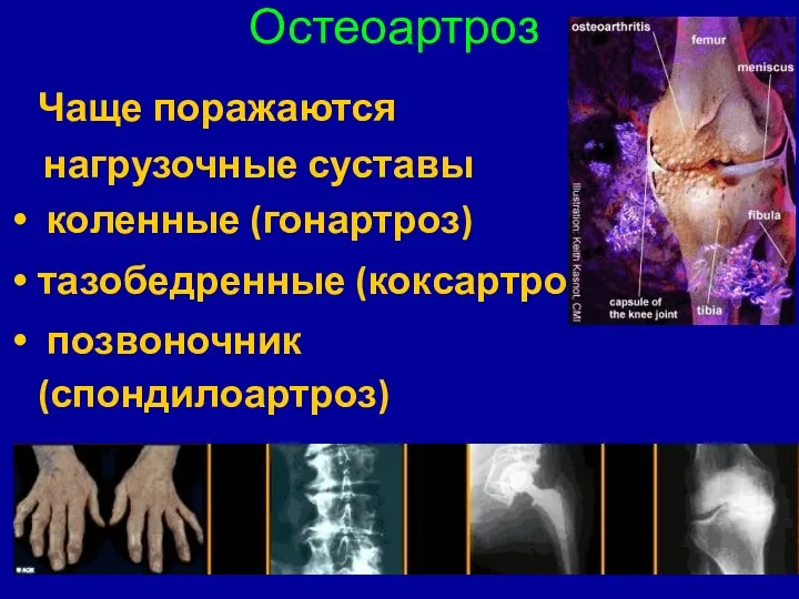 Остеоартроз Чаще поражаются нагрузочные суставы коленные (гонартроз) тазобедренные (коксартроз) позвоночник (спондилоартроз) кисти, стопы