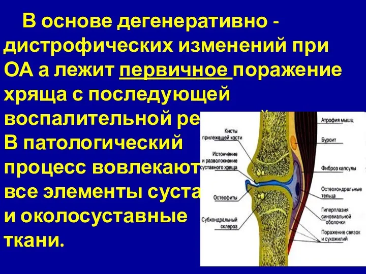 В основе дегенеративно -дистрофических изменений при ОА а лежит первичное