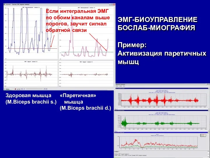 ЭМГ-БИОУПРАВЛЕНИЕ БОСЛАБ-МИОГРАФИЯ Пример: Активизация паретичных мышц Здоровая мышца (M.Biceps brachii s.) «Паретичная» мышца (M.Biceps brachii d.)