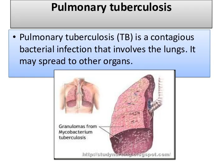 Pulmonary tuberculosis Pulmonary tuberculosis (TB) is a contagious bacterial infection that involves the