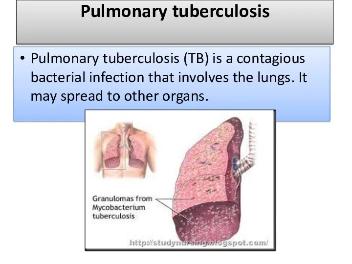 Pulmonary tuberculosis Pulmonary tuberculosis (TB) is a contagious bacterial infection