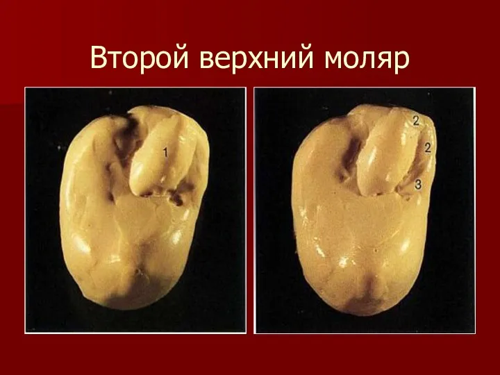 Второй верхний моляр