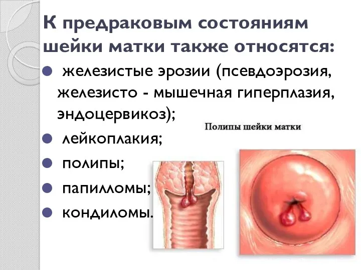 К предраковым состояниям шейки матки также относятся: железистые эрозии (псевдоэрозия,