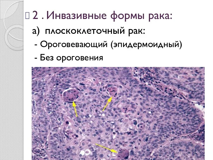 2 . Инвазивные формы рака: а) плоскоклеточный рак: - Ороговевающий (эпидермоидный) - Без ороговения