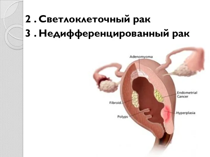 2 . Светлоклеточный рак 3 . Недифференцированный рак