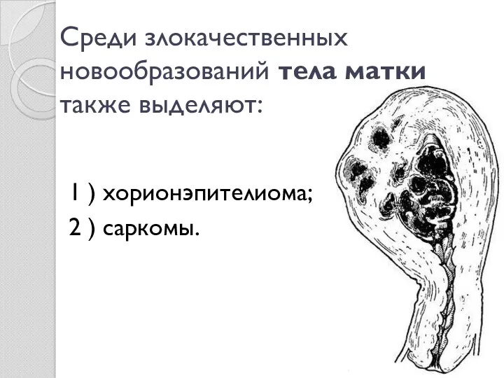 Среди злокачественных новообразований тела матки также выделяют: 1 ) хорионэпителиома; 2 ) саркомы.