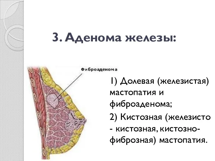 3. Аденома железы: 1) Долевая (железистая) мастопатия и фиброаденома; 2) Кистозная (железисто - кистозная, кистозно-фиброзная) мастопатия.