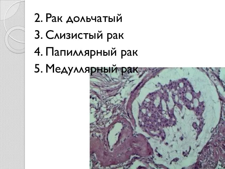 2. Рак дольчатый 3. Слизистый рак 4. Папиллярный рак 5. Медуллярный рак