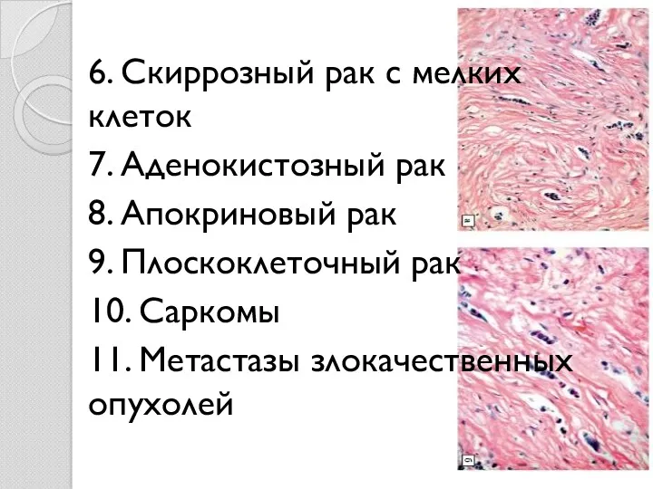 6. Скиррозный рак с мелких клеток 7. Аденокистозный рак 8.