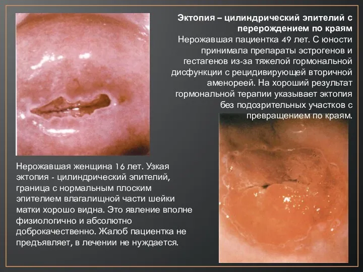 Нерожавшая женщина 16 лет. Узкая эктопия - цилиндрический эпителий, граница