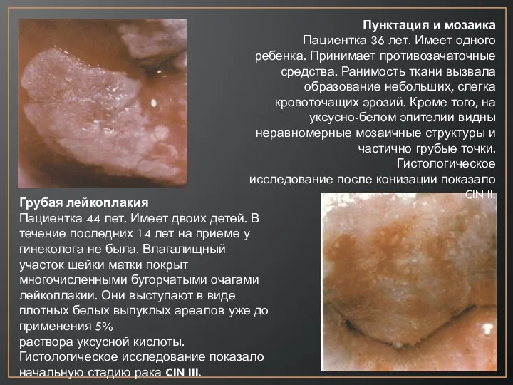 Грубая лейкоплакия Пациентка 44 лет. Имеет двоих детей. В течение