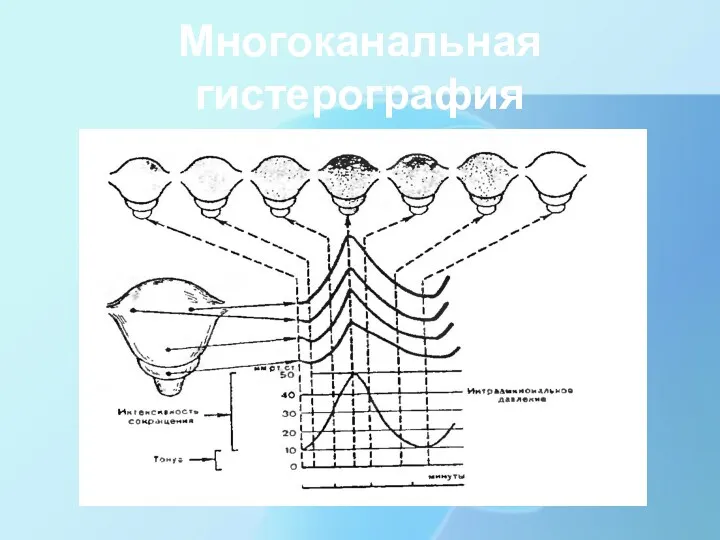 Многоканальная гистерография