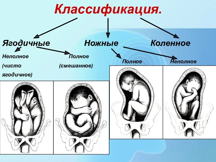 Классификация. Ягодичные Ножные Коленное Полное Неполное Неполное Полное (чисто (смешанное) ягодичное)