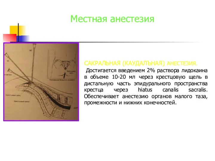 Местная анестезия САКРАЛЬНАЯ (КАУДАЛЪНАЯ) АНЕСТЕЗИЯ. Достигается введением 2% раствора лидокаина