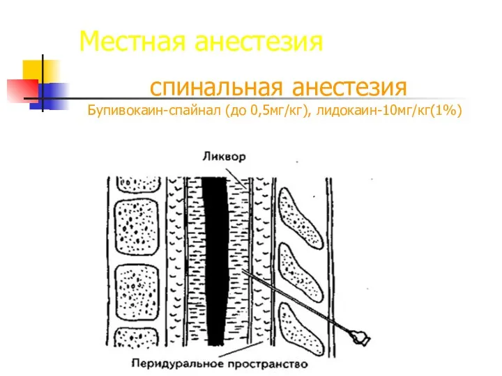 Местная анестезия спинальная анестезия Бупивокаин-спайнал (до 0,5мг/кг), лидокаин-10мг/кг(1%)