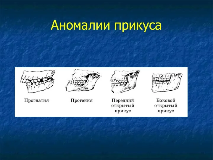 Аномалии прикуса