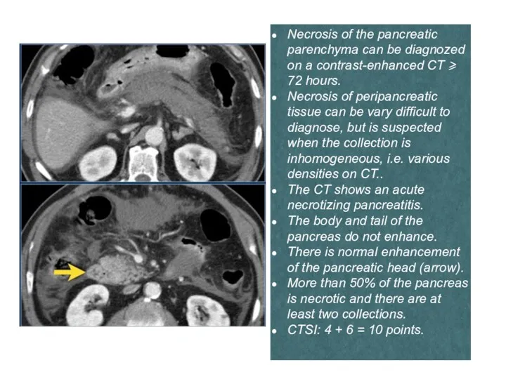 Necrosis of the pancreatic parenchyma can be diagnozed on a