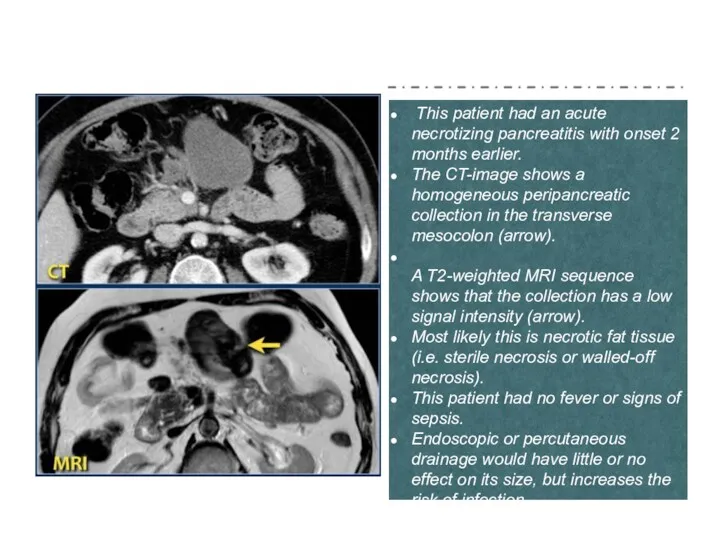 This patient had an acute necrotizing pancreatitis with onset 2