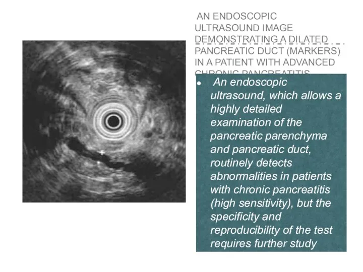 AN ENDOSCOPIC ULTRASOUND IMAGE DEMONSTRATING A DILATED PANCREATIC DUCT (MARKERS)