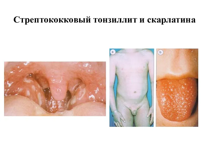 Стрептококковый тонзиллит и скарлатина