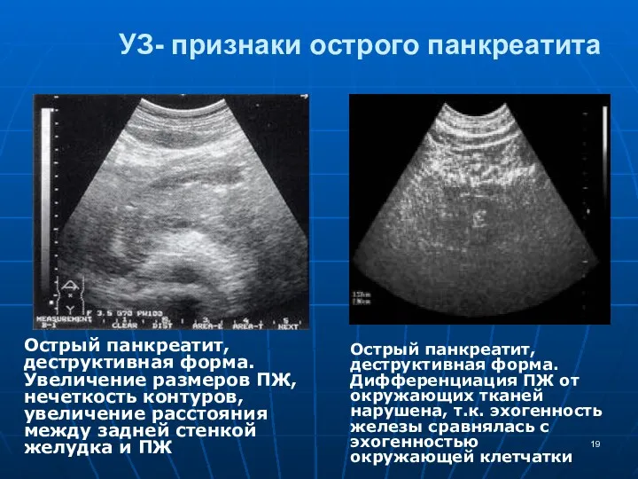 УЗ- признаки острого панкреатита Острый панкреатит, деструктивная форма. Увеличение размеров