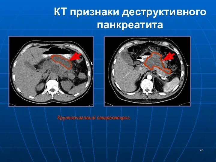 КТ признаки деструктивного панкреатита Крупноочаговый панкреонекроз.