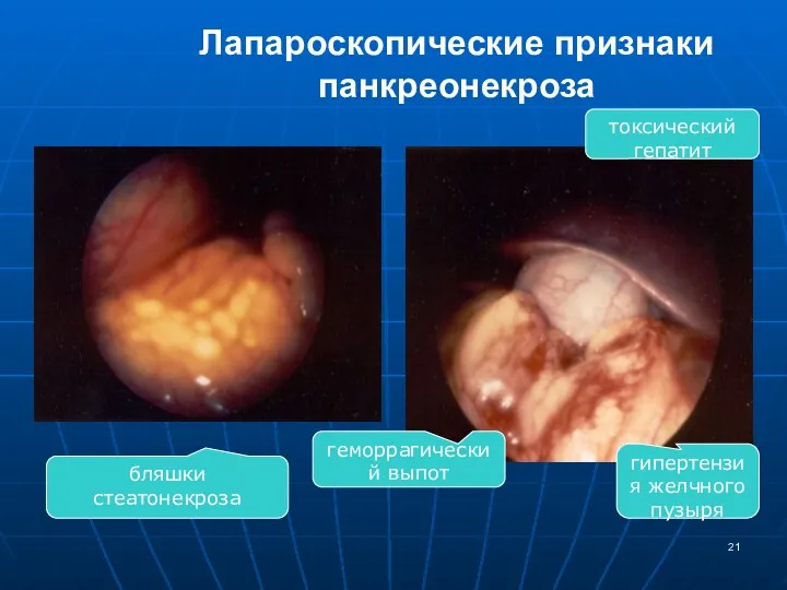 Лапароскопические признаки панкреонекроза бляшки стеатонекроза геморрагический выпот гипертензия желчного пузыря токсический гепатит