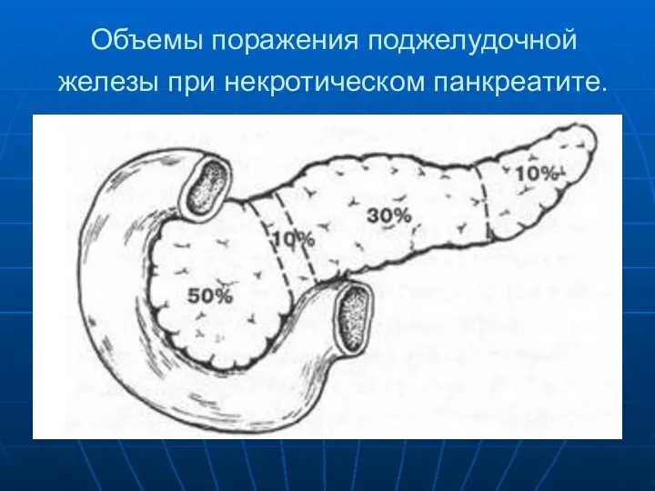 Объемы поражения поджелудочной железы при некротическом панкреатите.