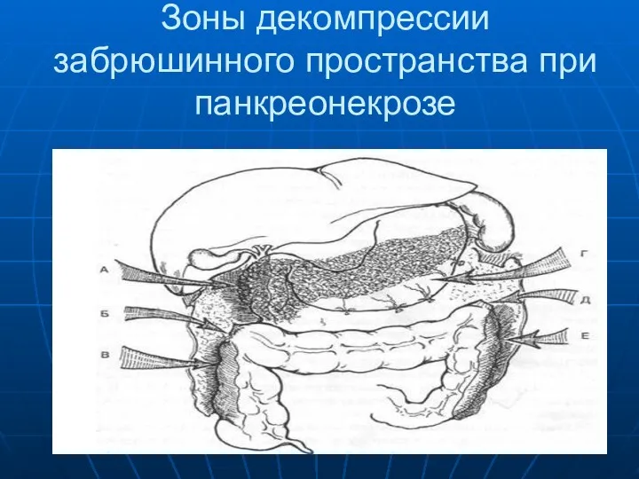 Зоны декомпрессии забрюшинного пространства при панкреонекрозе