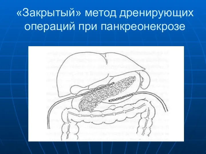 «Закрытый» метод дренирующих операций при панкреонекрозе