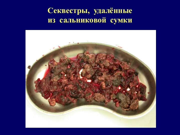 Секвестры, удалённые из сальниковой сумки