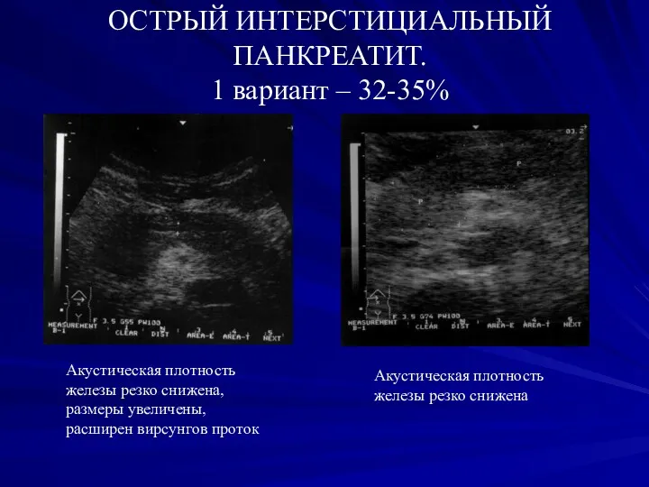 ОСТРЫЙ ИНТЕРСТИЦИАЛЬНЫЙ ПАНКРЕАТИТ. 1 вариант – 32-35% Акустическая плотность железы