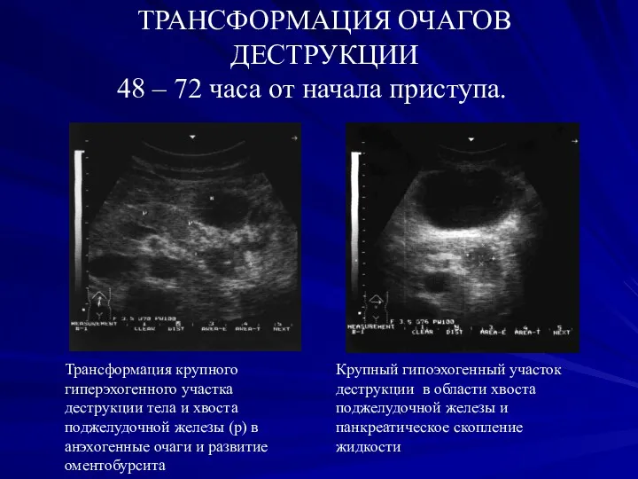 ТРАНСФОРМАЦИЯ ОЧАГОВ ДЕСТРУКЦИИ 48 – 72 часа от начала приступа.