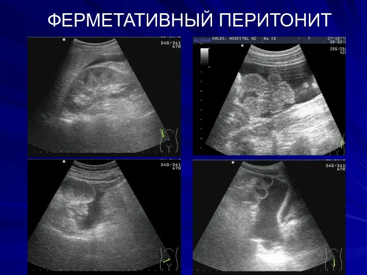 ФЕРМЕТАТИВНЫЙ ПЕРИТОНИТ