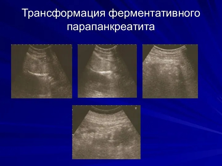 Трансформация ферментативного парапанкреатита