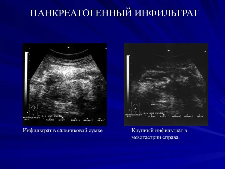 ПАНКРЕАТОГЕННЫЙ ИНФИЛЬТРАТ Инфильтрат в сальниковой сумке Крупный инфильтрат в мезогастрии справа.