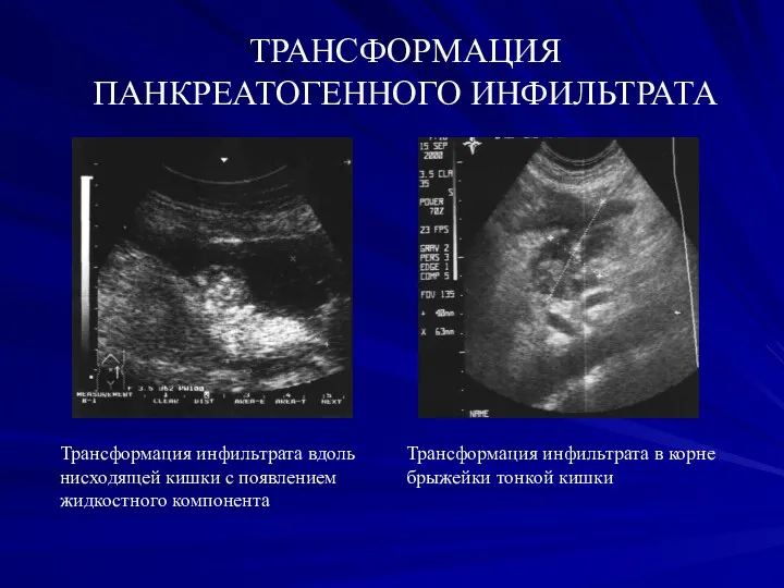 Трансформация инфильтрата вдоль нисходящей кишки с появлением жидкостного компонента ТРАНСФОРМАЦИЯ