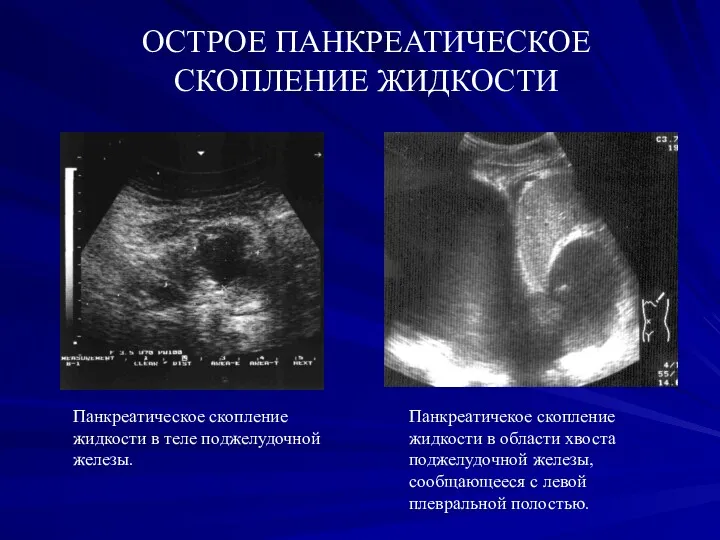 ОСТРОЕ ПАНКРЕАТИЧЕСКОЕ СКОПЛЕНИЕ ЖИДКОСТИ Панкреатическое скопление жидкости в теле поджелудочной